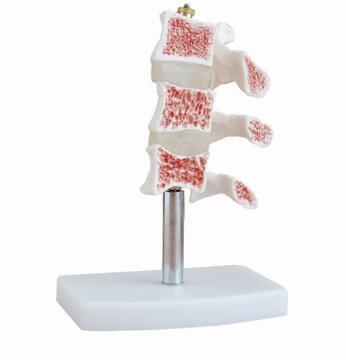Bix-A1015 Human Osteoporosis Anatomical Model (3 vertebrae)