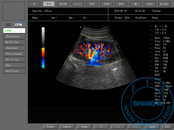 Color Doppler Ultrasound (DopScan 8000)