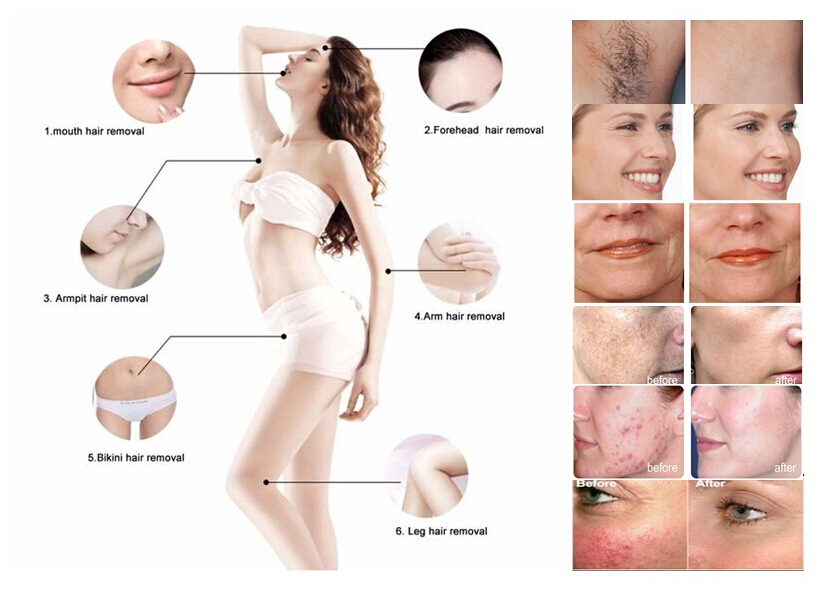 Ce Approved Multifunctional Hair Removal Opt +Elight+ RF + Shr