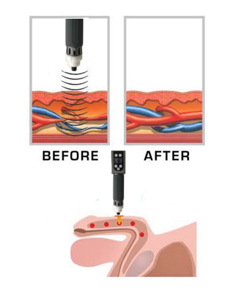 Portable Physical Shockwave Machine Shock Wave Therapy for Bone Healing