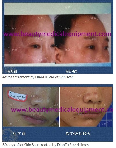 Dianfu Star 10 Times Effects of CO2 Fractional Laser Therapy Equipment