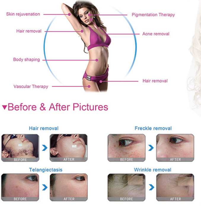 Shr Elight Hair Removal Laser