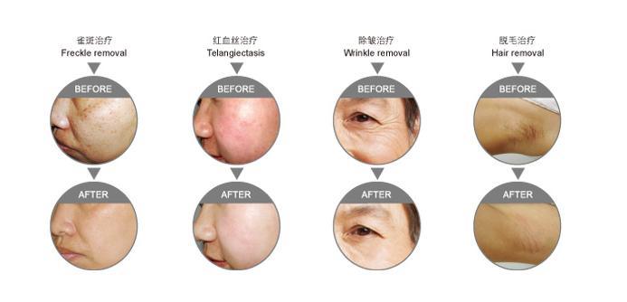 Hair Removal Rejuvenation Elight IPL RF Beauty Machine