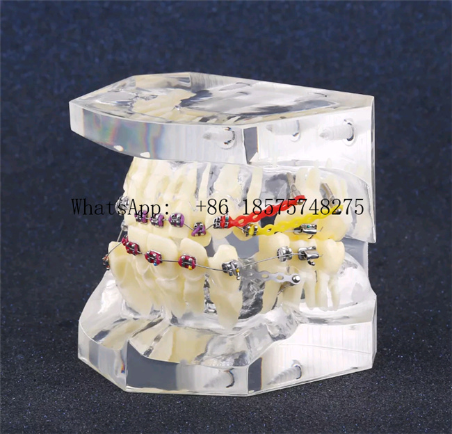 Malocclusion Model with Brackets Chain Wire Dental Tooth Model