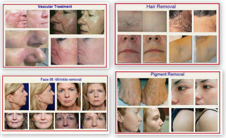 IPL E-Light / IPL Hair Removal Shr / Shr