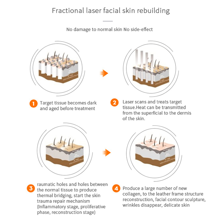 CO2 Laser Cute for Deep Wrinkles