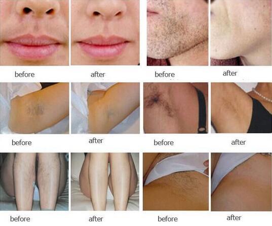 IPL RF Technology Face Lifting Hair Removal Skin Rejuvenation