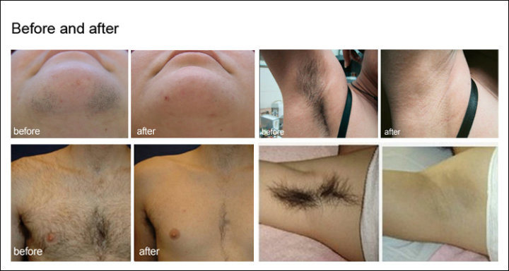 Permanent 808nm Diode Laser Hair Removal for Home Use