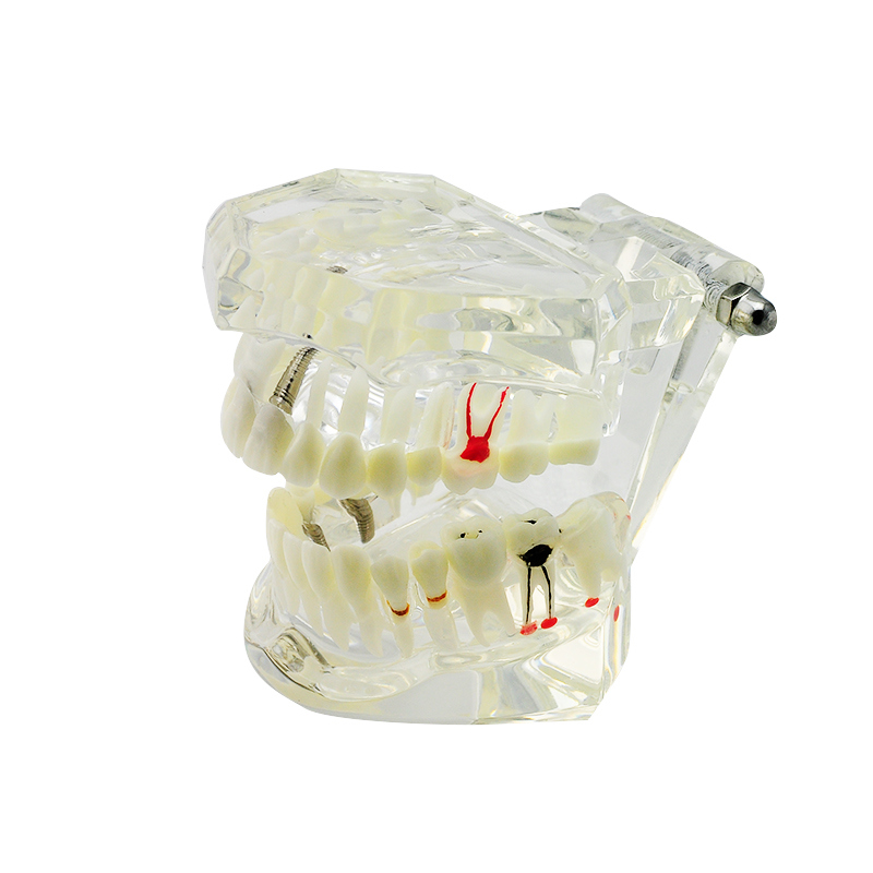 Dental Implant Model Dental Implant Disease Teeth Model with Restoration & Bridge Tooth