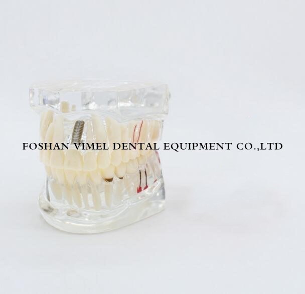 Dental Study Tooth Transparent Pathological Teeth Model for Adult Teaching