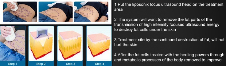 Professional Liposonix Hifu Slimming Machine for Body Fast Weight Loss