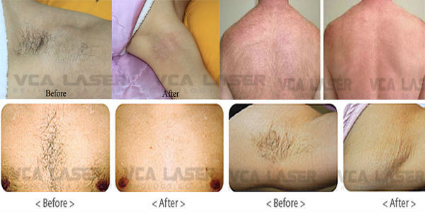 808 Laser System Permanent Hair Removal 808nm Laser