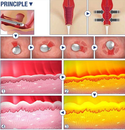 Stantionary Vaginal Tightening Scar Removal CO2 Fractional Laser Machine