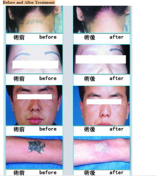 Q-Switched ND: YAG Laser Tattoo-Removal System +Carbon Peeling + Nail Fungus Removal