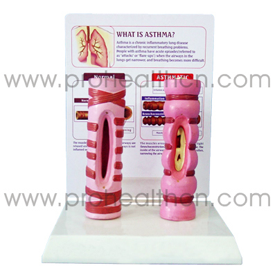 Education Medical Asthma Anatomical Model