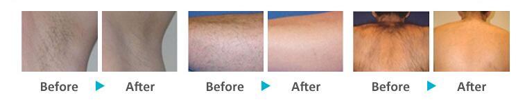 Effective Diode Laser Hair Removal Combined with 755mm 808mm 1064mm