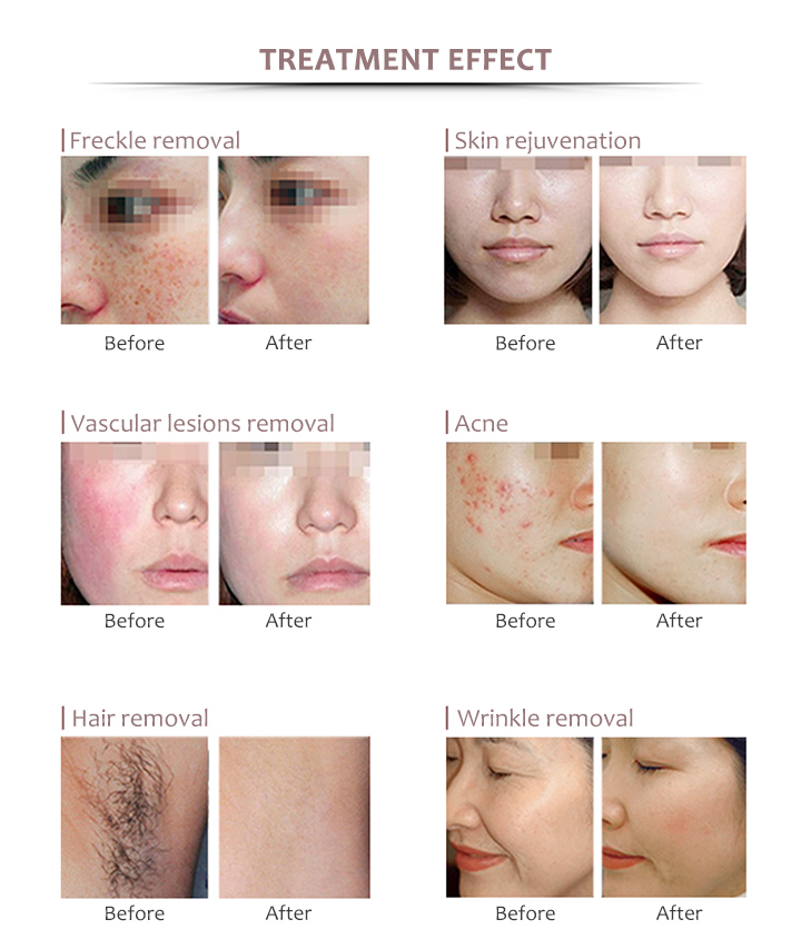 IPL Laser Skin Rejuvenation Acne Removal