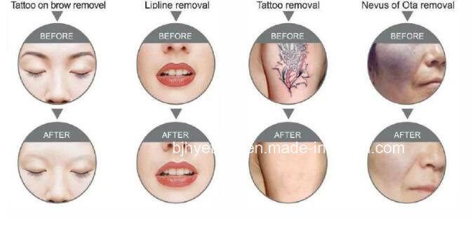 Q Switch ND YAG Laser Permanent Tattoo Removal and Eyebrow Laser Tattoo Removal