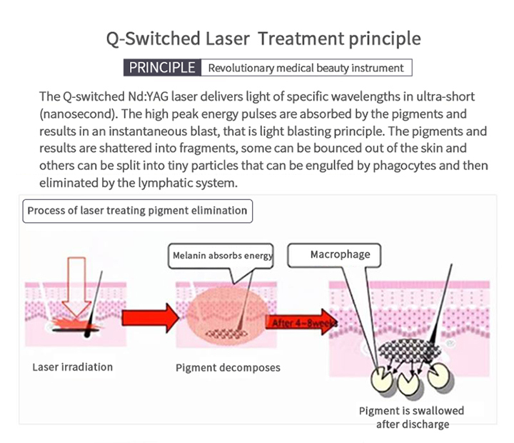 2000mj Laser Tattoo Removal Beauty Machine for Pigment Removal