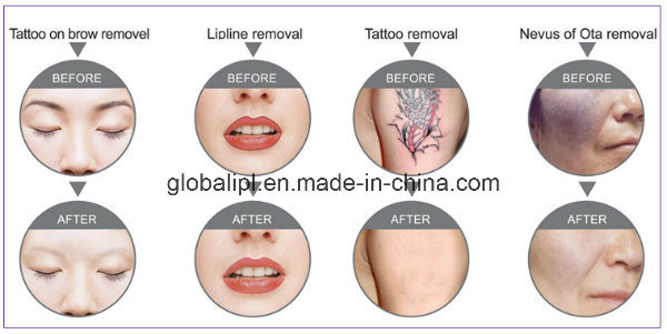 FDA Approved ND YAG Laser-Tattoo-Removal-Machine-Price