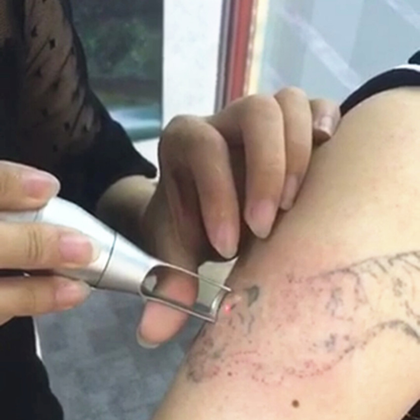 Laser Pen for Spot Tattoo Acne Removal