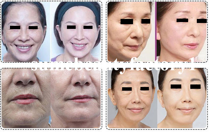 Portable Hifu Skin Tighten and Facial Lifting Salon Machine Wrinkles Removal