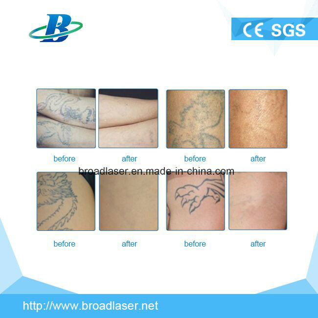 Q-Switch Portable Green Color Tattoo Removal ND YAG Laser Machine