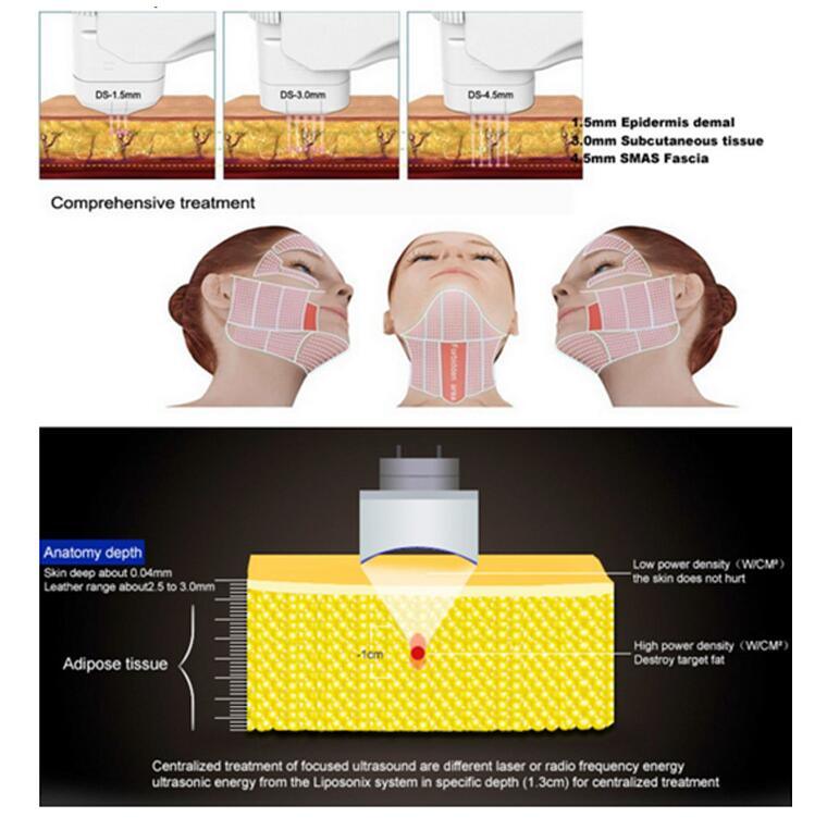 Liposonix Hifu Body Slimming Machine for Weight Loss and Face Lift