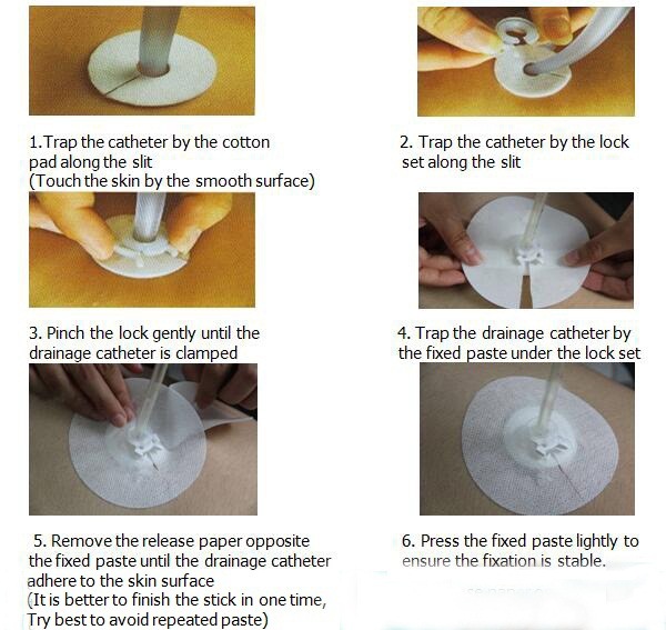 Chest Tube Drainage Lung Drainage Tube Fixation