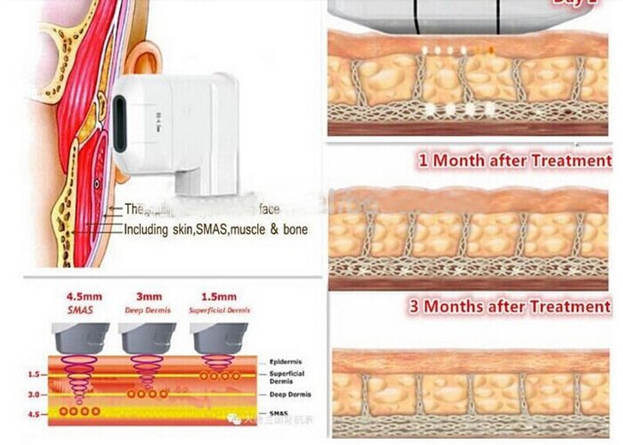 Hifu, High Intensity Frequency Ultrasound Skin Wrinkles Removal