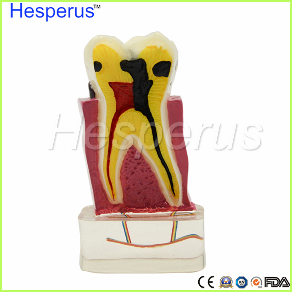 4: 1 Dentist Dental Study Teach Tooth Model Teeth Disease Model