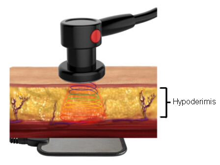 Resistive Electric Transfer Ret Machine