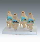 Xy-3334-2 Model of Pathology Knee