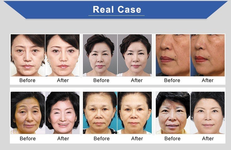 Wrinkle Removal Hifu Face Lift Machine