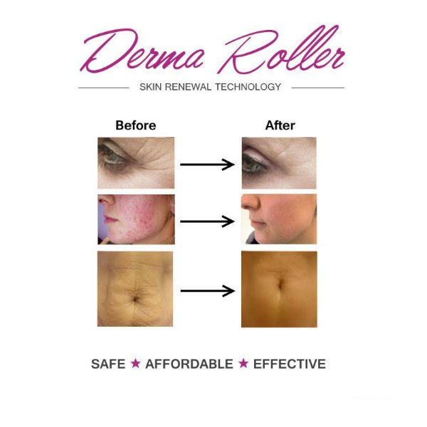 Drs Derma 40 Stamp Roller Titanium Micro Needle Dermaroller System for Skin Care