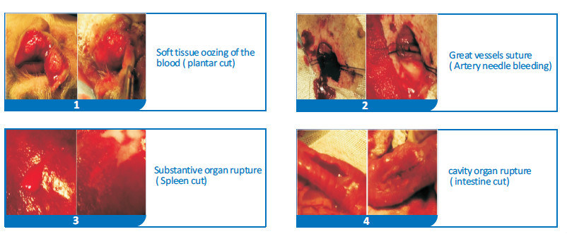 a New Hemostatic Agent When Endoscopy