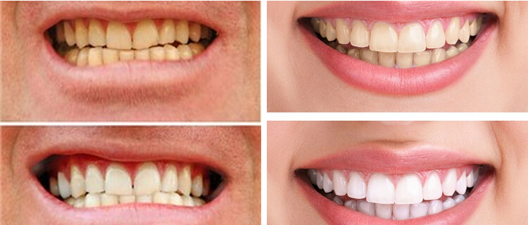 OEM Professional Bleaching Gel Teeth Whitening Teeth Whitening Kit