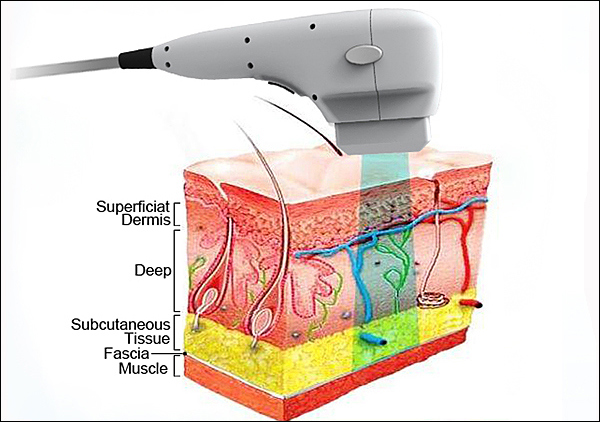 Professional High Intensity Focused Ultrasound Hifu Face Lifting Machine