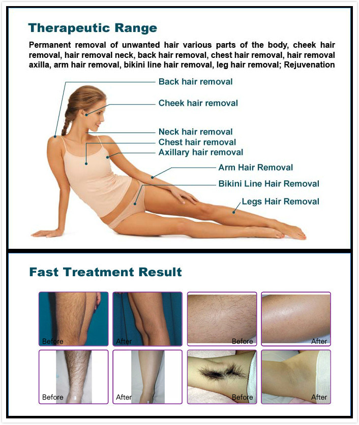 Permanent Hair Removal Germany Diode Laser with Ce RoHS