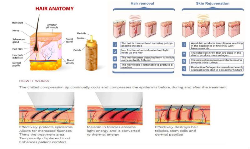 Shr IPL RF Hair Removal Used on Skin Rejuvenation