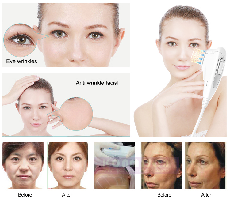 Professional Beauty Salon Use Body Slimming Skin Tightening Hifu Machine