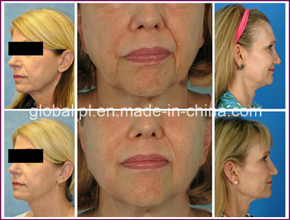 Skin Tightening Face Lifting Hifu Machine Face Lift