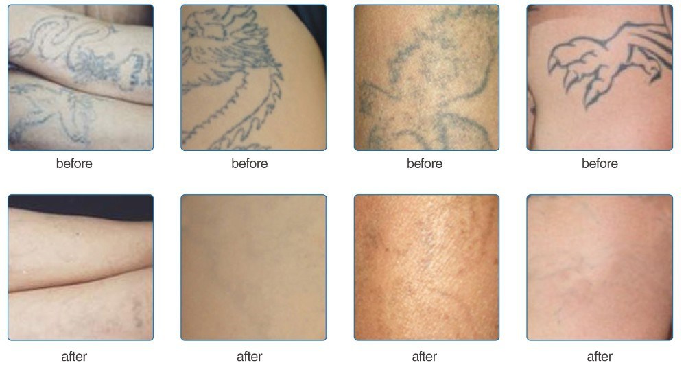Q-Switched ND: YAG Laser Tattoo Removal Machine