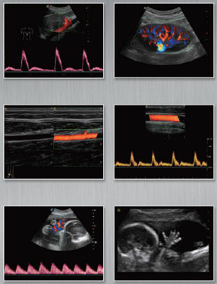 Medical Equipment Sonoscape S22 Cardiac Ultrasound Scanner, Cardiac Echo Doppler