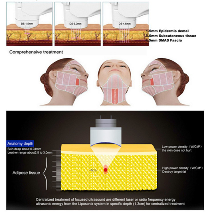 Medical Ce Hifu Face Lifting and Body Slimming Liposonix Beauty Machine for Sale