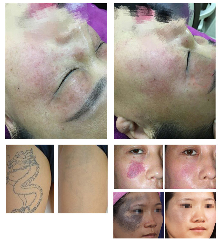 Picosecond Laser Tattoo Pigmentation Freckle Removal Machine