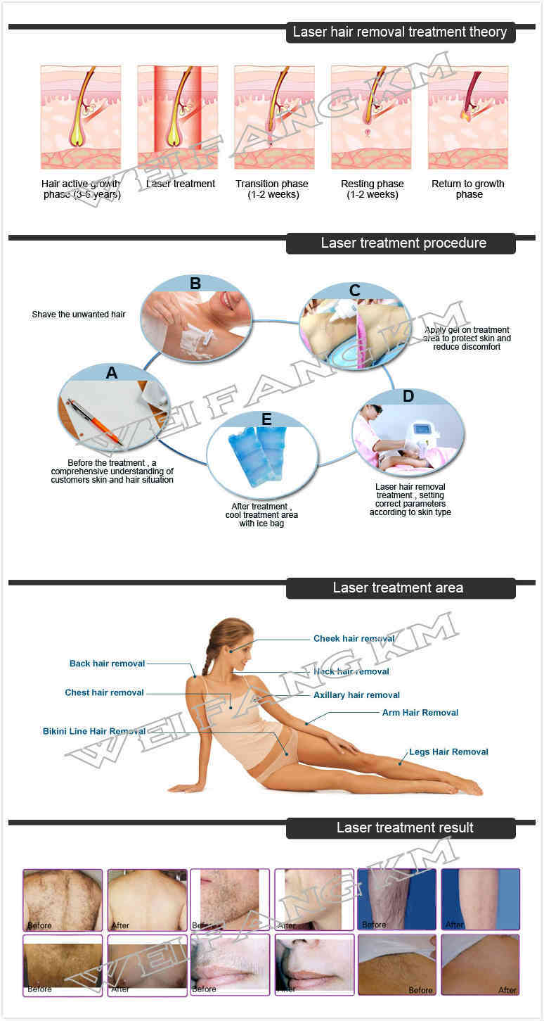 All Skin Type 808 755 1064 Laser Diode Permanent Hair Removal