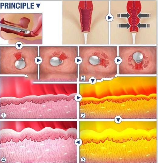 CO2 Fractional Laser Vaginal Tightening Beauty Equipment