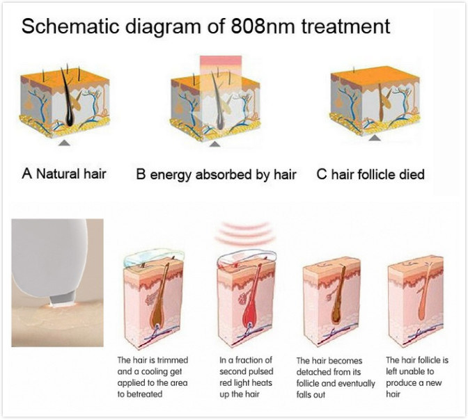 808nm for Permanent Fast Hair Removal