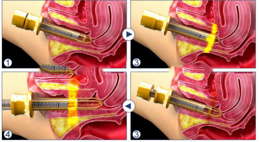 Fractional CO2 Laser Vaginal Tightening